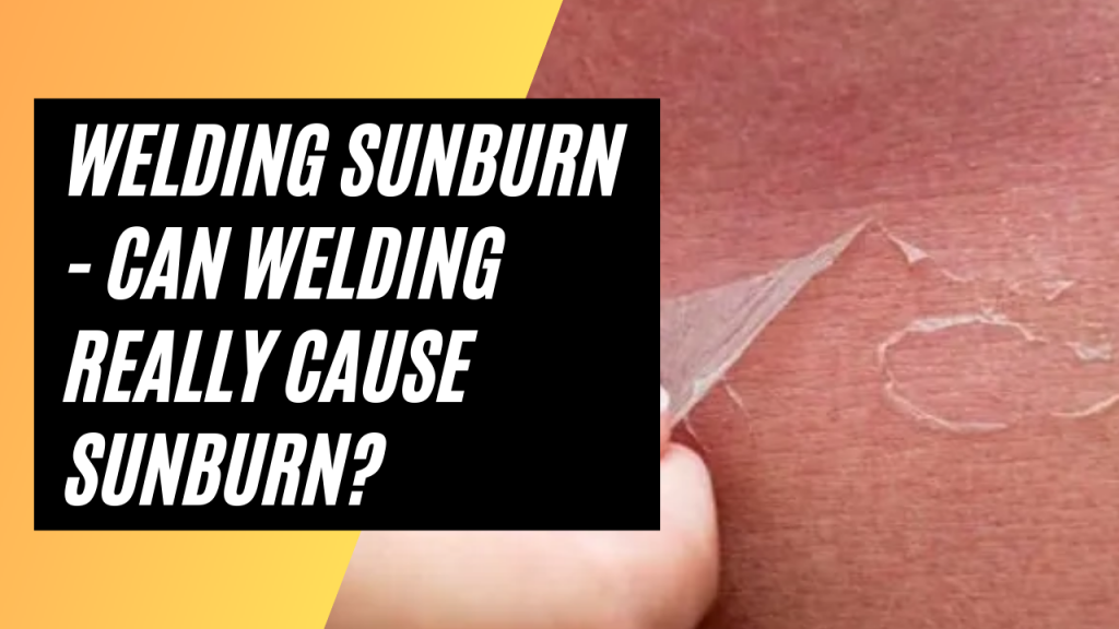 Welding Sunburn